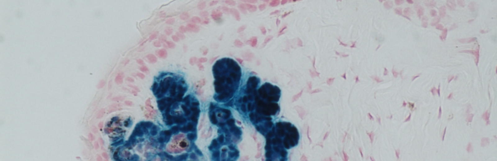This image shows a tumour