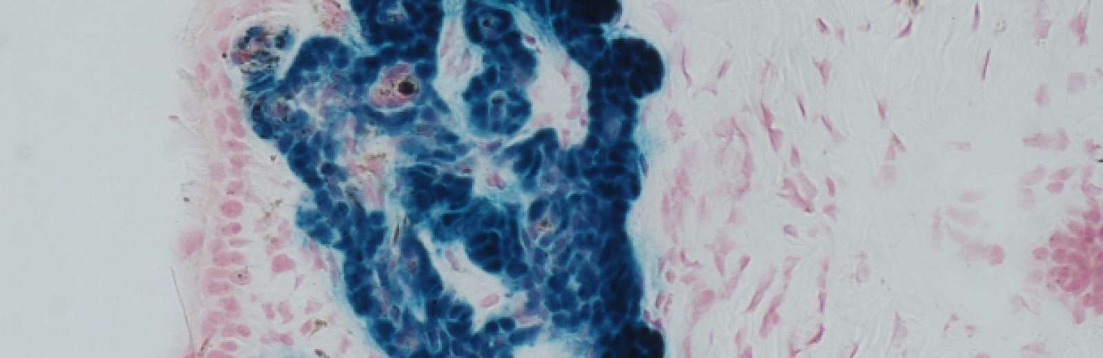 This image shows a tumour